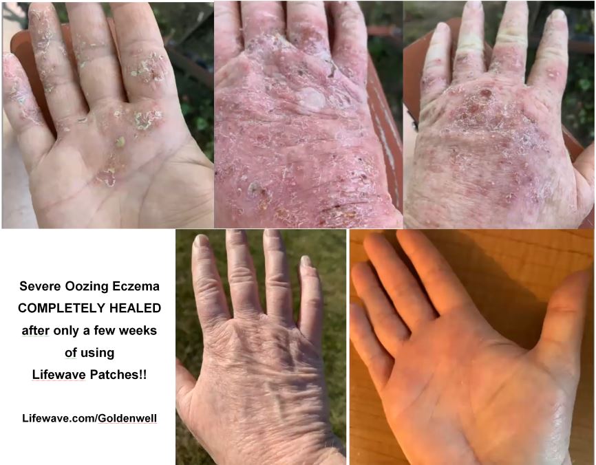 Eczema